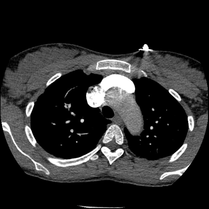 Acute chest syndrome - sickle cell disease (Radiopaedia 42375-45499 Axial C+ CTPA 52).jpg