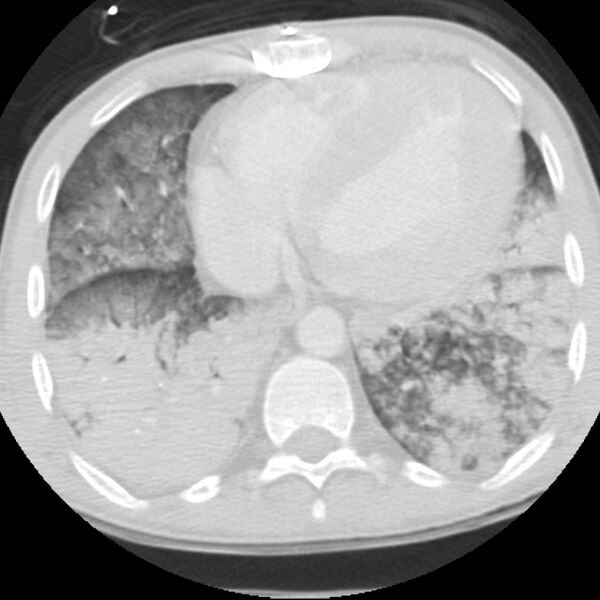 File:Acute diffuse alveolar hemorrhage (Radiopaedia 41323-44158 Axial lung window 45).jpg