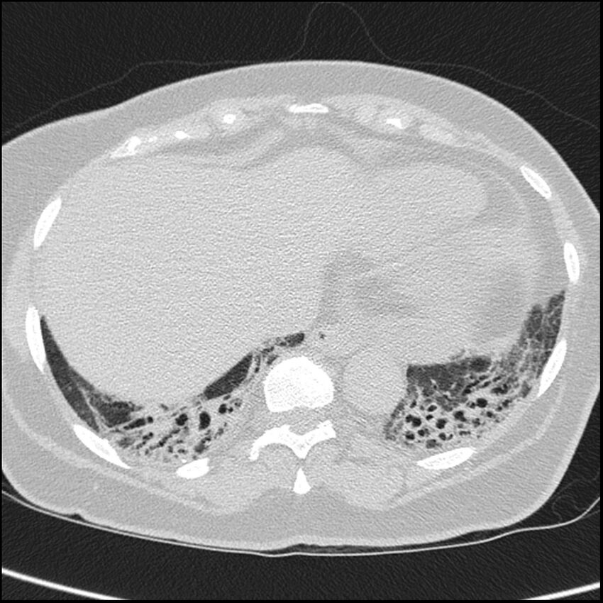 Acute interstitial pneumonitis (Radiopaedia 45404-49453 Axial lung window 64).jpg