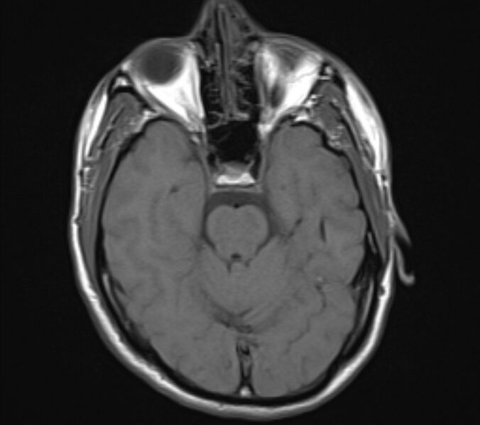 File:Acute ischemic stroke - posterior circulation territory (Radiopaedia 77670-89880 Axial T1 9).jpg