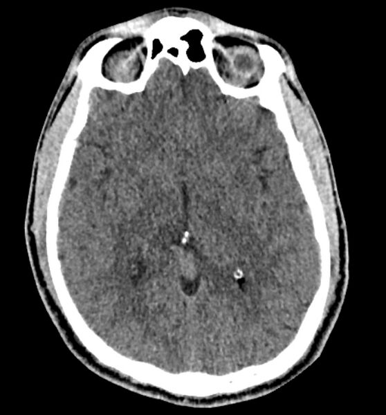 File:Acute ischemic stroke - posterior circulation territory (Radiopaedia 77670-89881 non-contrast 43).jpg