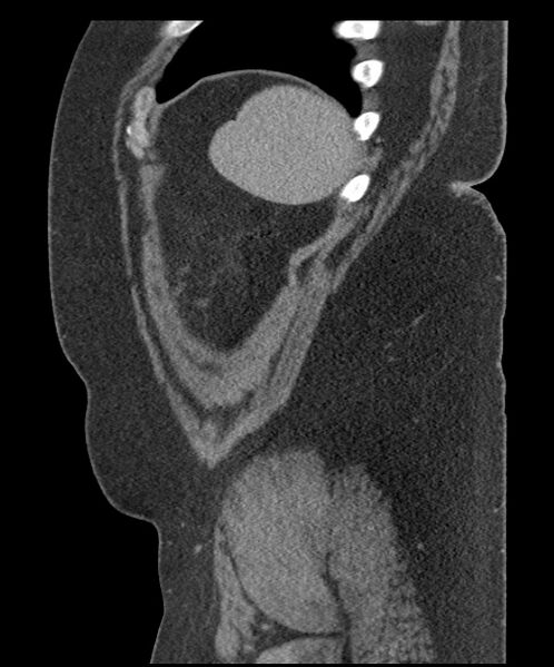 File:Acute mesenteric venous ischemia (Radiopaedia 46041-50383 Sagittal C+ portal venous phase 106).jpg