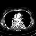 Acute myocardial infarction in CT (Radiopaedia 39947-42415 Axial C+ arterial phase 75).jpg