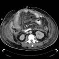 Acute pancreatic necrosis (Radiopaedia 13560-18503 Axial C+ portal venous phase 40).jpg