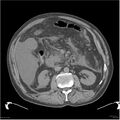 Acute pancreatitis (Radiopaedia 19135-19116 Axial non-contrast 21).jpg