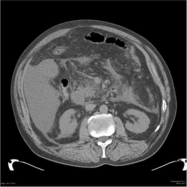 File:Acute pancreatitis (Radiopaedia 19135-19116 Axial non-contrast 21).jpg