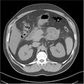 Acute pancreatitis - mild (Radiopaedia 27796-28033 Axial non-contrast 12).jpg