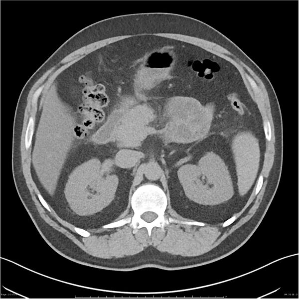 File:Acute pancreatitis - mild (Radiopaedia 27796-28033 Axial non-contrast 12).jpg