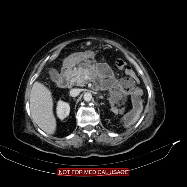 File:Acute pancreatitis with infected necrosis (Radiopaedia 26454-26585 Axial C+ portal venous phase 8).jpg