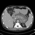 Acute pancreatitis with walled off pancreatic necrosis (Radiopaedia 6438-7797 Axial C+ portal venous phase 2).jpg