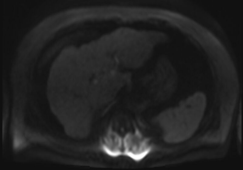 File:Acute portal vein thrombosis (Radiopaedia 73198-83925 Axial DWI 72).jpg