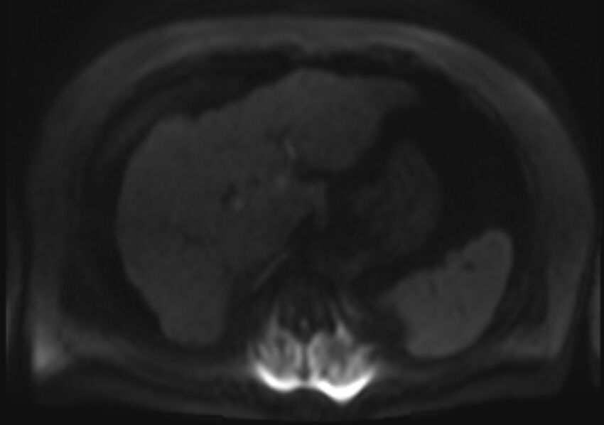 Acute portal vein thrombosis (Radiopaedia 73198-83925 Axial DWI 72).jpg