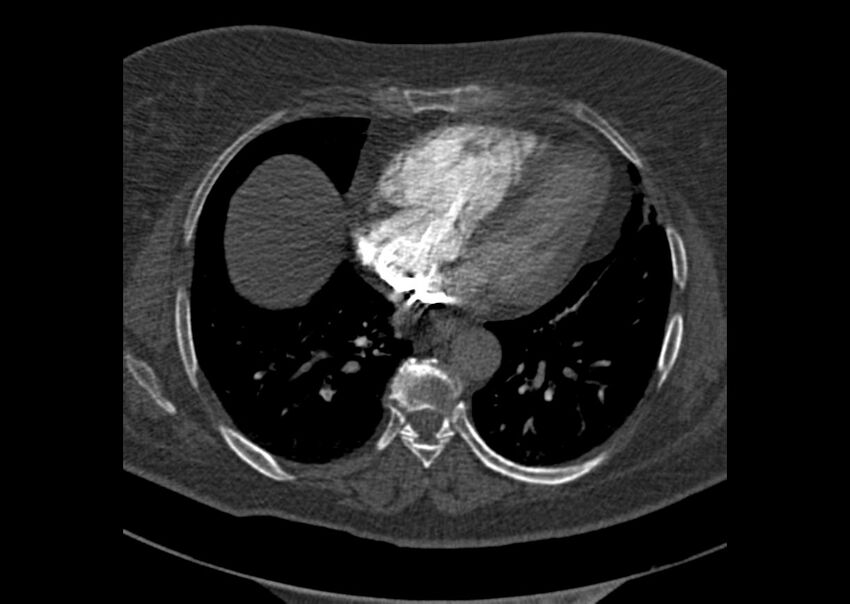 Acute pulmonary embolism (Radiopaedia 29938-30466 Axial C+ CTPA 147).jpg