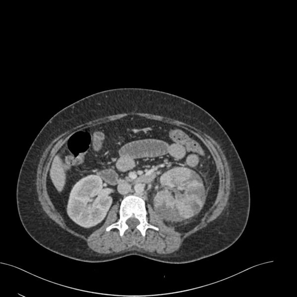 File:Acute pyelonephritis with renal vein thrombosis (Radiopaedia 58020-65053 Axial renal parenchymal phase 68).jpg