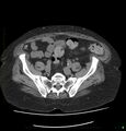 Acute renal failure post IV contrast injection- CT findings (Radiopaedia 47815-52557 Axial non-contrast 61).jpg