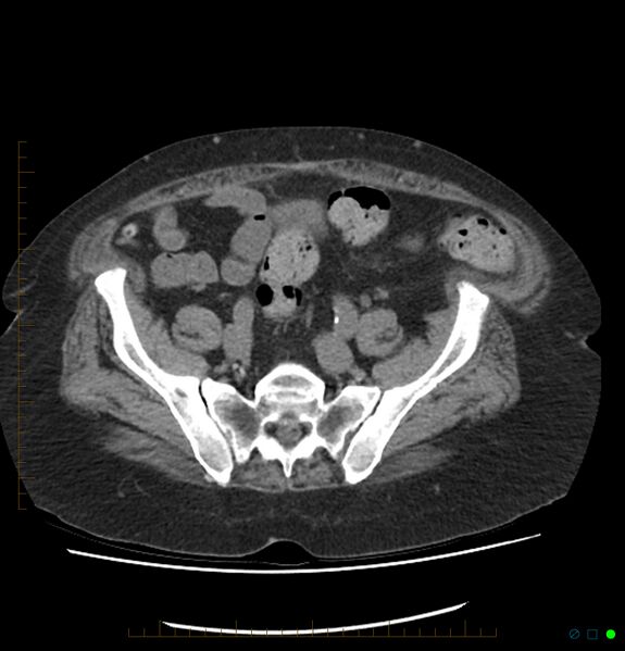 File:Acute renal failure post IV contrast injection- CT findings (Radiopaedia 47815-52557 Axial non-contrast 61).jpg