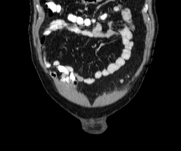 File:Acute sigmoid colon diverticulitis (Radiopaedia 55507-61976 Coronal C+ portal venous phase 6).jpg