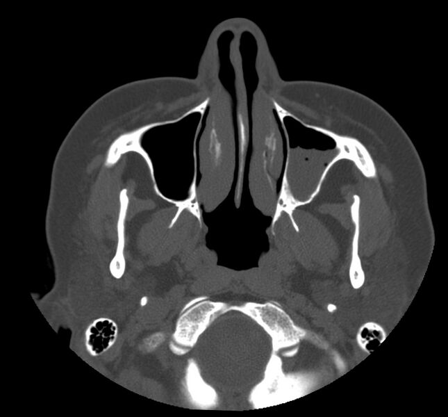 File:Acute sinusitis (Radiopaedia 22419-22455 Axial non-contrast 8).jpg