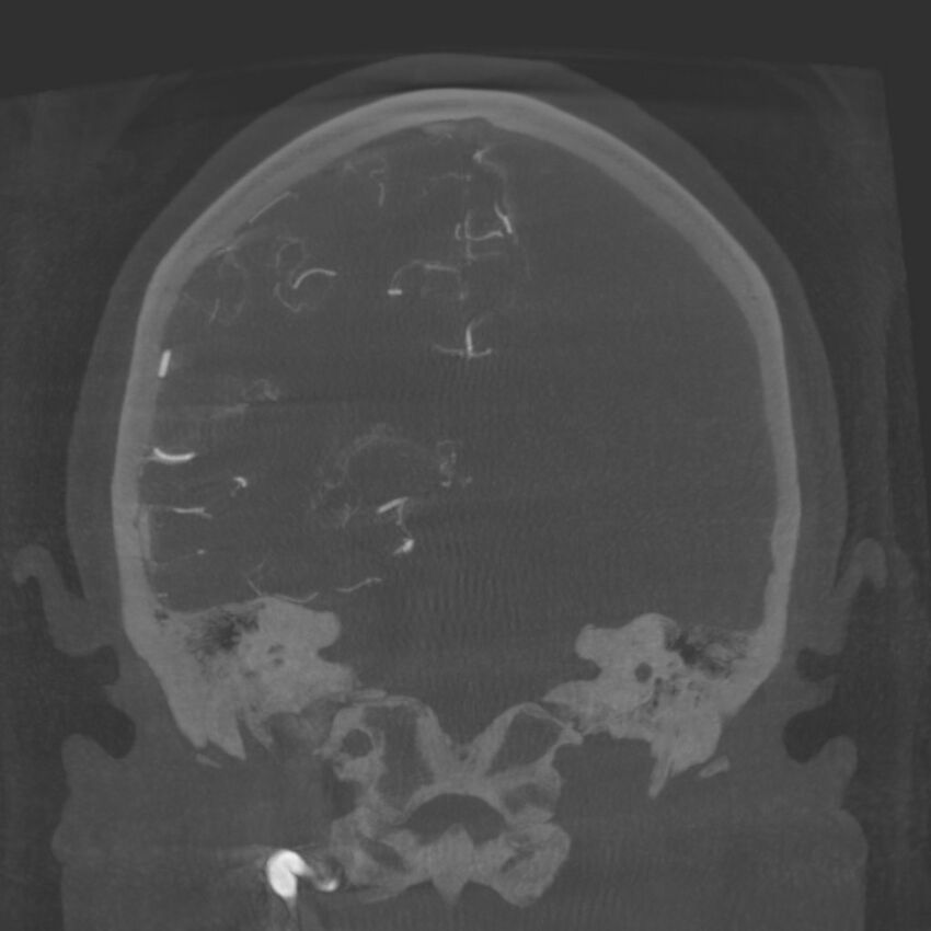 Acute subarachnoid hemorrhage and accessory anterior cerebral artery (Radiopaedia 69231-79010 Coronal arterial - MIP 64).jpg