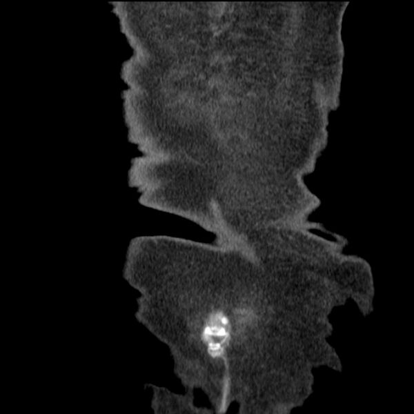 File:Acute tubular necrosis (Radiopaedia 28077-28334 G 80).jpg