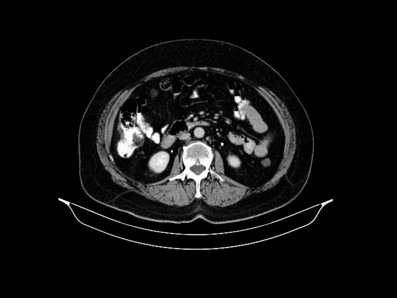 File:Adenocarcinoma of pancreas with hepatic metastasis (Radiopaedia 64332-73122 Axial C+ delayed 50).jpg