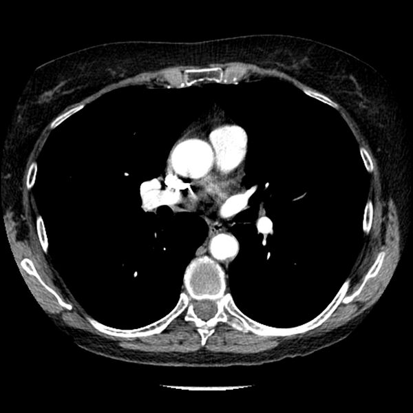 File:Adenocarcinoma of the lung (Radiopaedia 41015-43755 Axial C+ portal venous phase 58).jpg