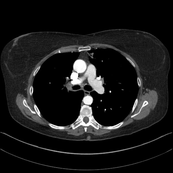 File:Adenocarcinoma of the lung (Radiopaedia 44205-47803 Axial C+ portal venous phase 37).jpg