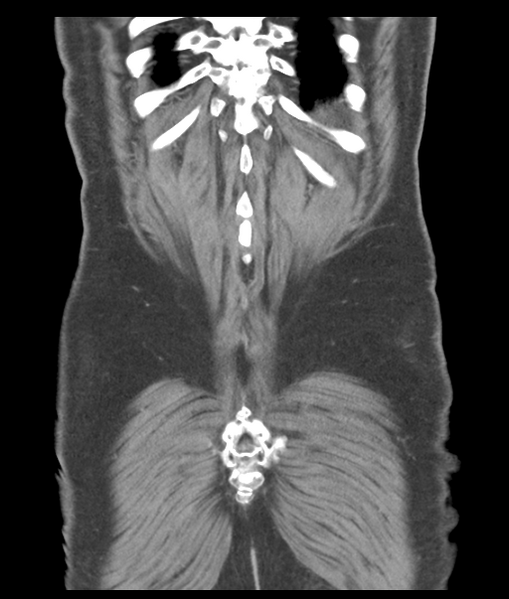 File:Adenocarcioma of rectum- T1 lesion (Radiopaedia 36921-38547 Coronal C+ portal venous phase 56).png