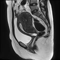 Adenomyosis - ovarian endometriomas (Radiopaedia 67031-76350 Sagittal T2 14).jpg