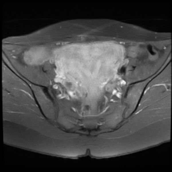 File:Adenomyosis within a septate uterus (Radiopaedia 69963-79981 Axial T1 C+ fat sat 11).jpg