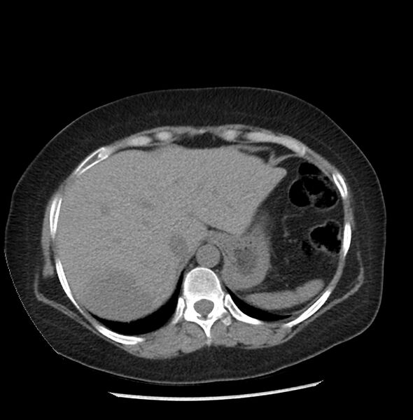 File:Adrenal cortical carcinoma with IVC invasion and thrombosis (Radiopaedia 34307-35597 Axial non-contrast 4).jpg