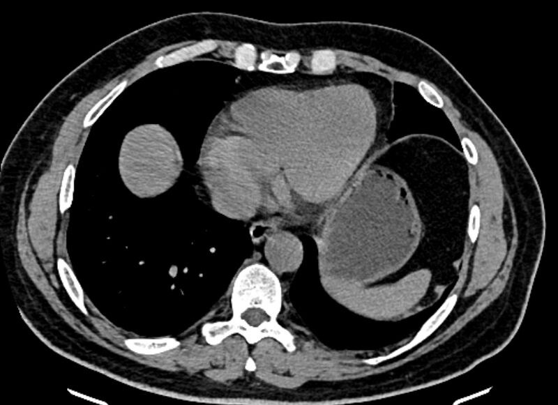 File:Adrenal metastases (Radiopaedia 73082-83791 Axial non-contrast 10).jpg