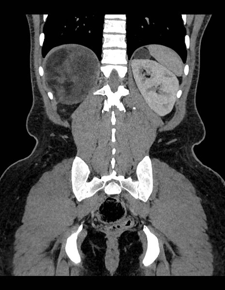 File:Adrenal myelolipoma - bilateral (Radiopaedia 74805-85810 Coronal C+ portal venous phase 90).jpg