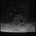 Aggressive vertebral hemangioma (Radiopaedia 39937-42404 Axial T1 C+ fat sat 21).png