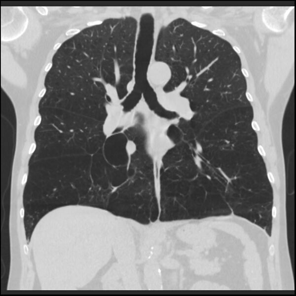 File:Alpha-1-antitrypsin deficiency (Radiopaedia 40993-43722 Coronal lung window 54).jpg