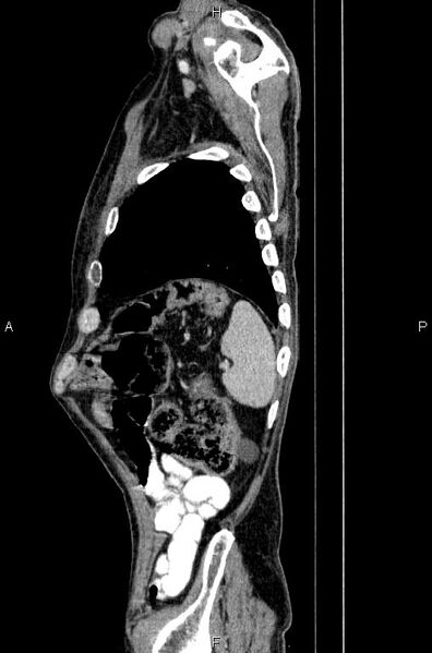 File:Ampullary adenocarcinoma (Radiopaedia 86093-102033 E 80).jpg