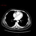 Ampullary carcinoma (Radiopaedia 56396-63056 B 2).jpg