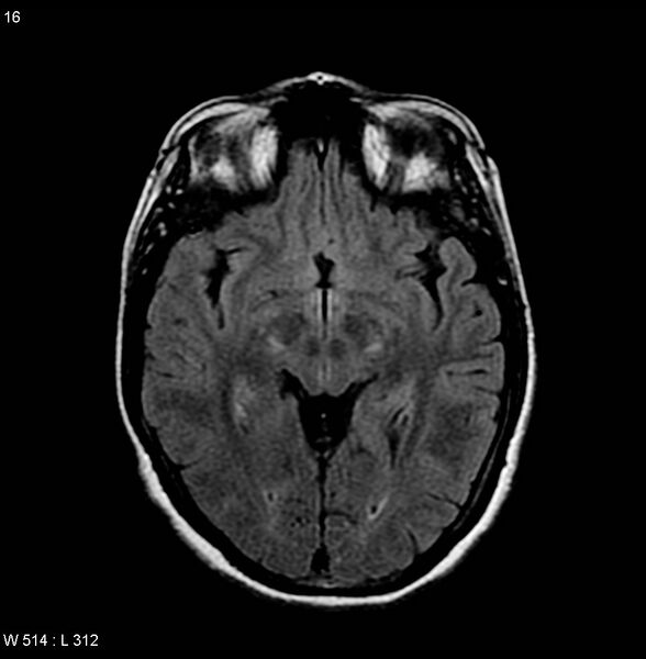 File:Amyotrophic lateral sclerosis (Radiopaedia 4719-6744 Axial FLAIR 3).jpg
