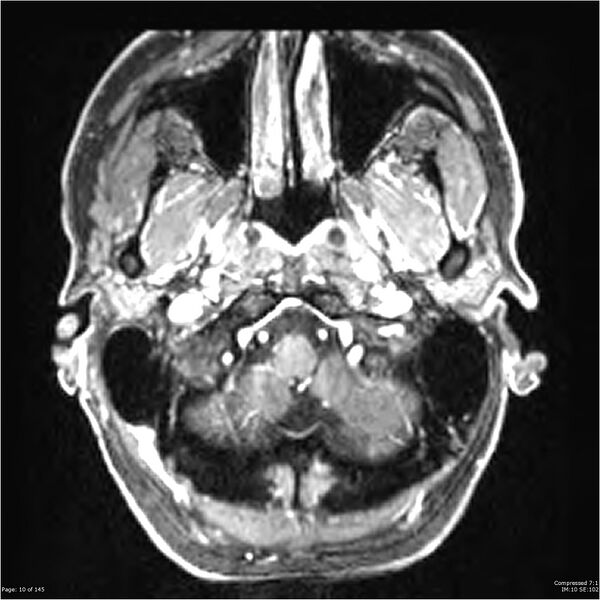 File:Anaplastic meningioma with recurrence (Radiopaedia 34452-35788 Axial T1 C+ 10).jpg
