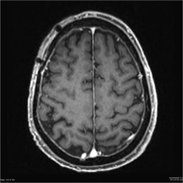 File:Anaplastic meningioma with recurrence (Radiopaedia 34452-35788 Axial T1 C+ 115).jpg