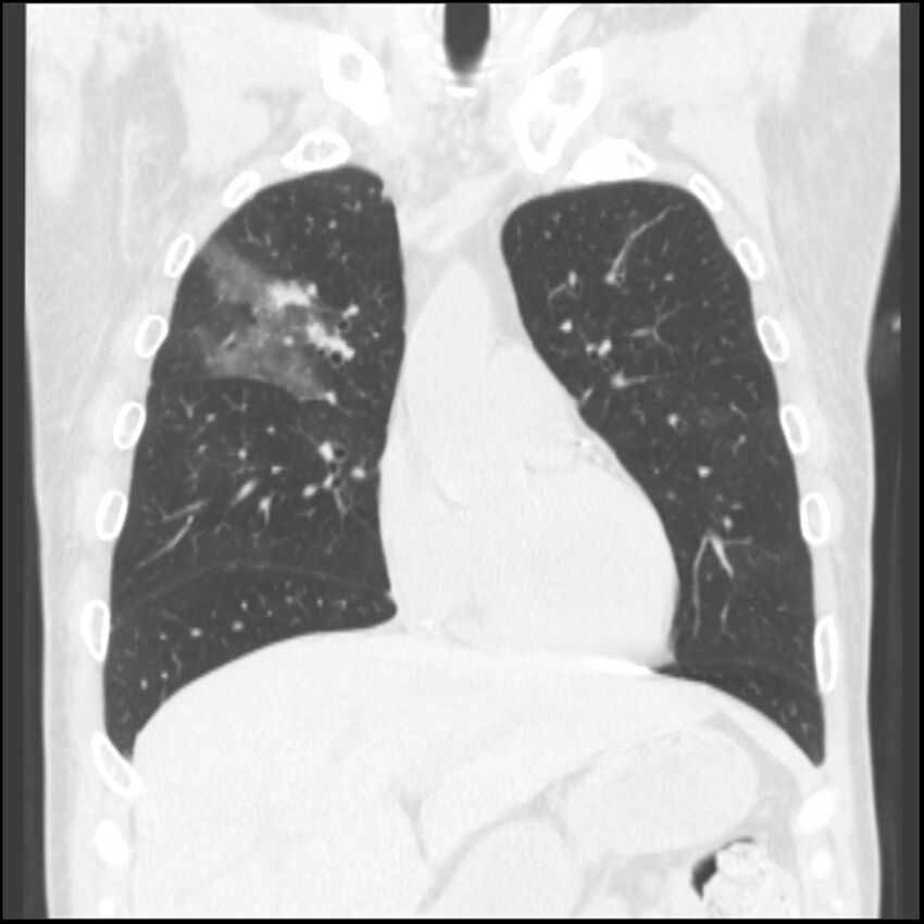 Angioinvasive aspergillosis (Radiopaedia 43957-47466 Coronal lung window 63).jpg