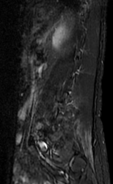 File:Ankylosing spondylitis - Andersson lesion (Radiopaedia 81878-95838 Sagittal STIR 11).jpg