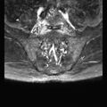 Ankylosing spondylitis with zygapophyseal arthritis (Radiopaedia 38433-40517 D 4).jpg