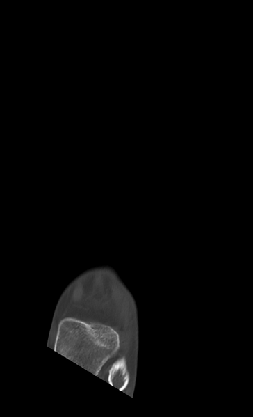 File:Anterior calcaneal process fracture (Radiopaedia 47384-51989 Axial bone window 5).png