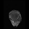 Anterior calcaneal process fracture (Radiopaedia 74654-85611 Axial PD fat sat 3).jpg