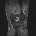 Anterior cruciate ligament full thickness tear (Radiopaedia 66268-75467 Coronal STIR 13).jpg