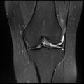 Anterior cruciate ligament tear, Wrisberg rip and bucket-handle tear of medial meniscus (Radiopaedia 75872-87266 Coronal PD fat sat 14).jpg