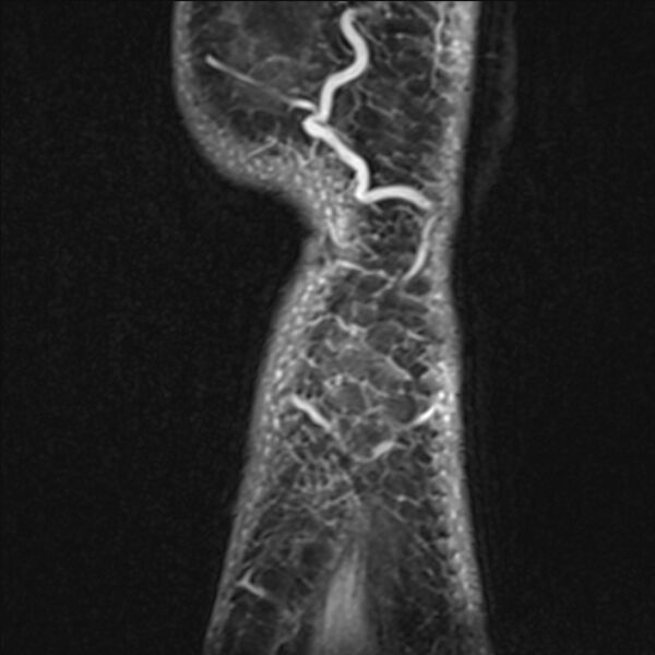 File:Anterior cruciate ligament tear - ramp lesion (Radiopaedia 71883-82322 Sagittal T1 vibe 5).jpg
