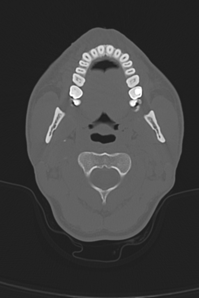 File:Anterior nasal spine fracture (Radiopaedia 46138-50494 Axial bone window 61).png