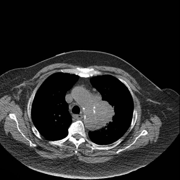 File:Aortic arch false aneurysm (Radiopaedia 14667-14587 Axial non-contrast 11).jpg